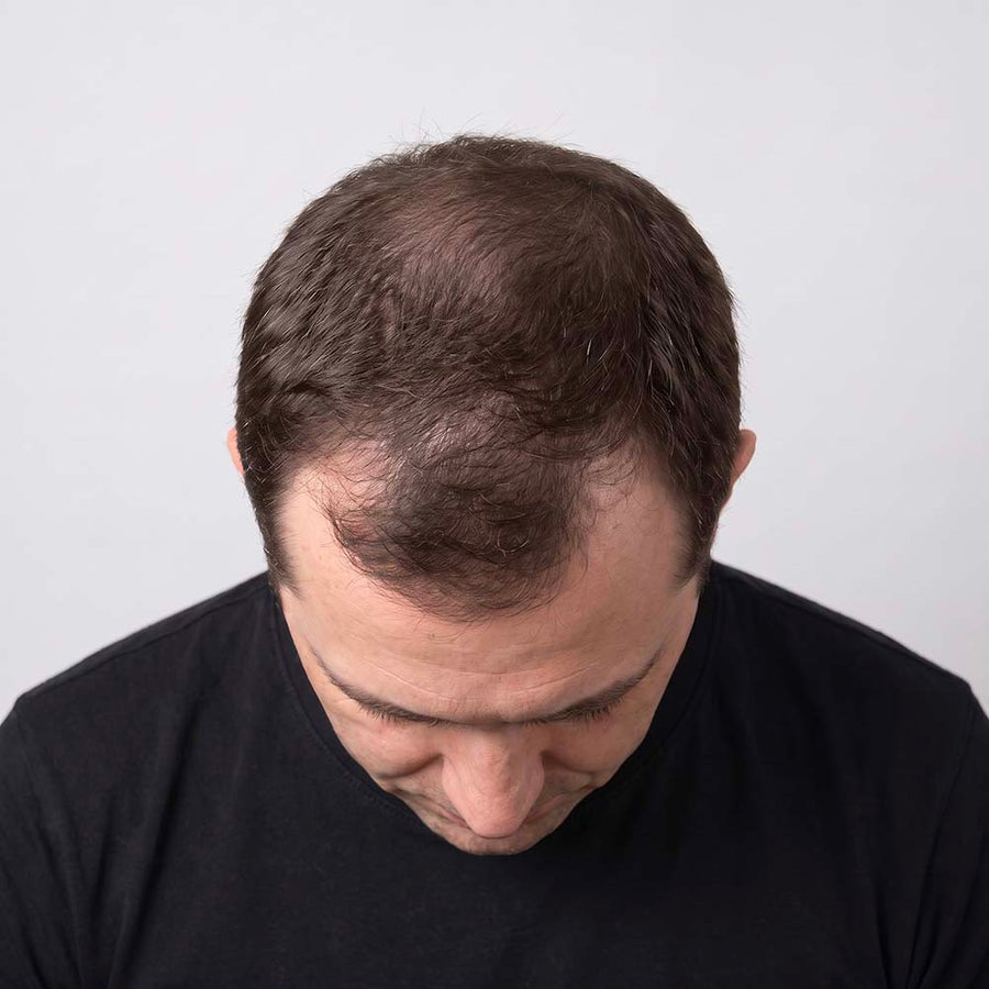Male hair growth process