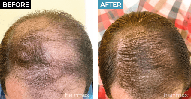 Before and After Results