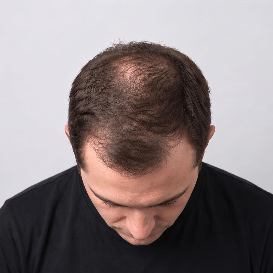 A close-up shot of a man looking down, showing thinning brown hair in moderate stages