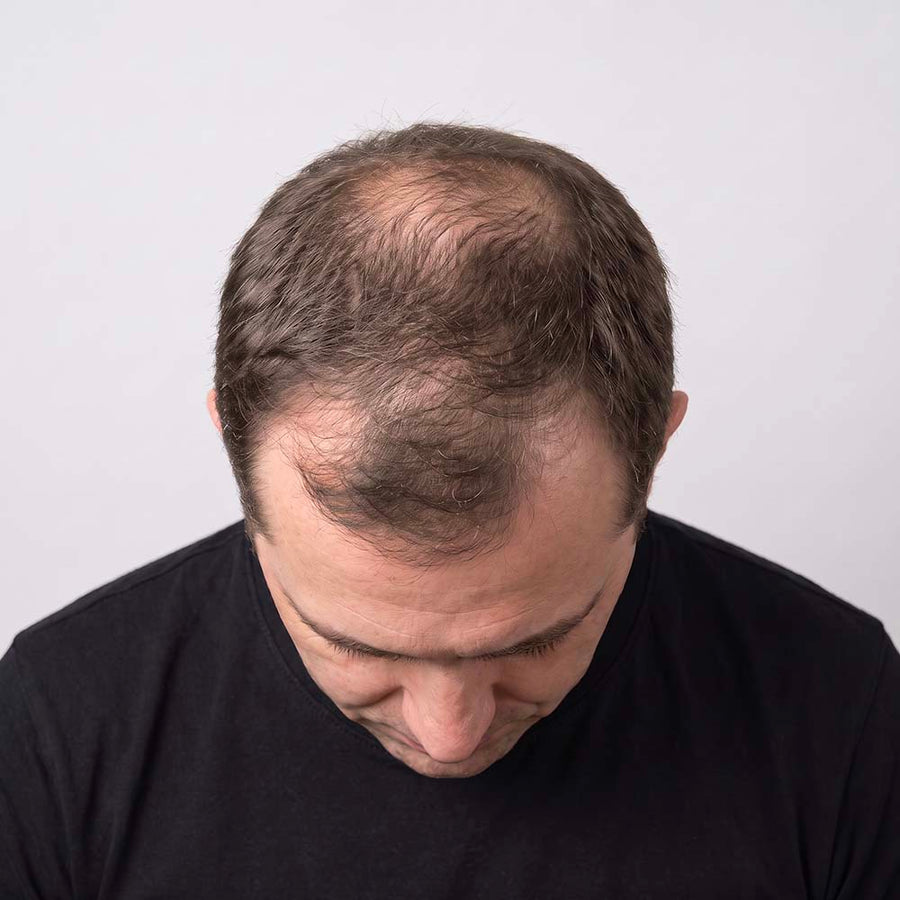 Male hair growth process