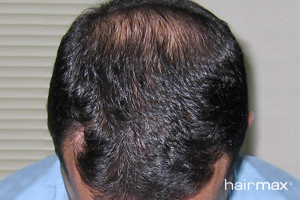 After 6 months treatment