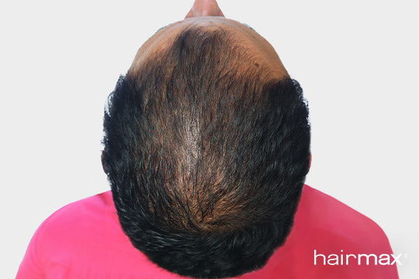 After 6 months treatment