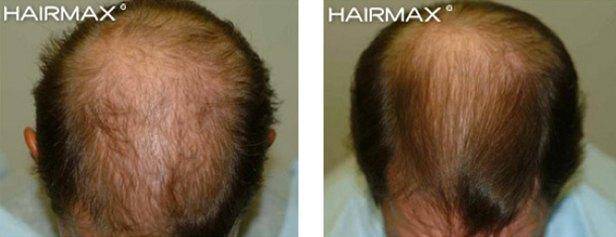 Before and After Plus Clinical Results Photos of Hair Growth Hairmax
