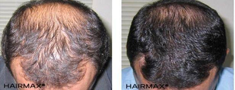 Before and After Plus Clinical Results Photos of Hair Growth – Hairmax