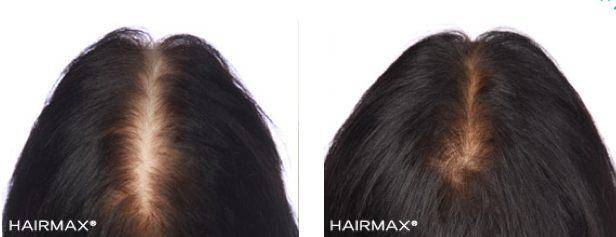 Hair max plus results best sale