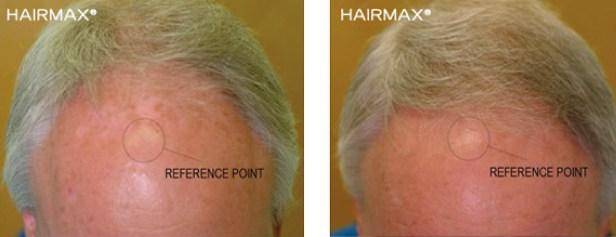 Hair max plus results best sale