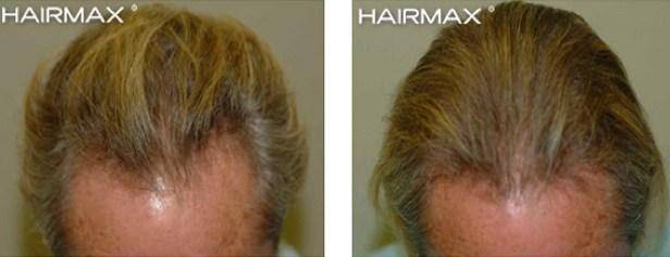 Before and After Plus Clinical Results Photos of Hair Growth Hairmax