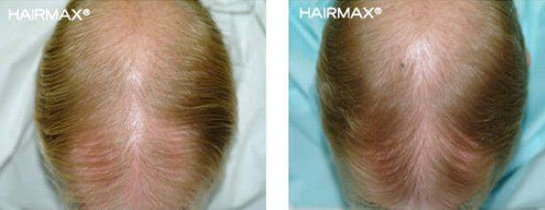 Before and After Plus Clinical Results Photos of Hair Growth– Hairmax