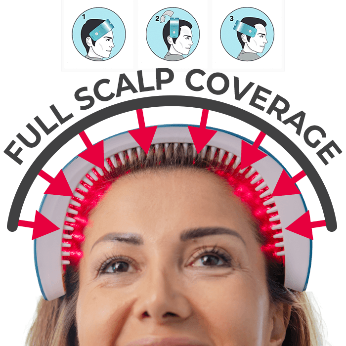 LaserBands – Full scalp Coverage