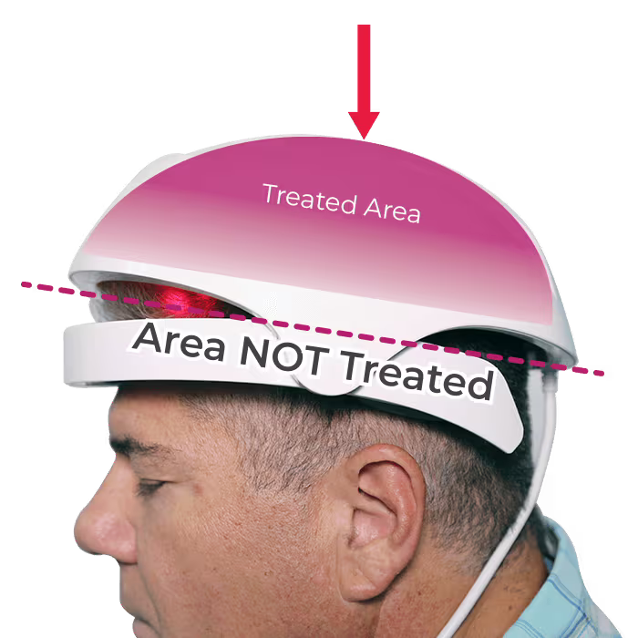 iRestore Device – Partial coverage