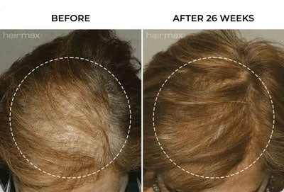 side-by-side before and after hair growth image