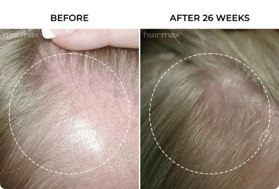 side-by-side before and after hair growth image